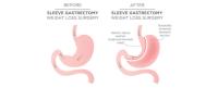 Gastric Sleeve Surgery image 5